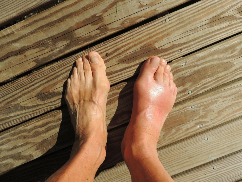 chikungunya pé inchado tornozelo inchado edema de tornozelo edema de pé dores nas juntas